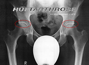 Hüftarthrose bei Läufern